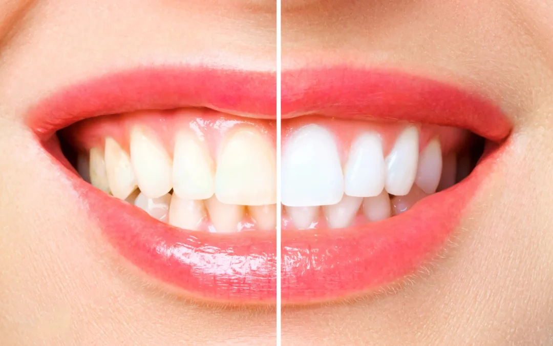 5 Foods that Naturally Whiten your Teeth